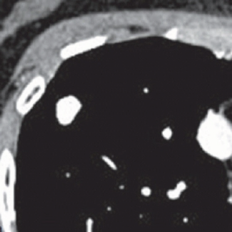 Complete Calcification