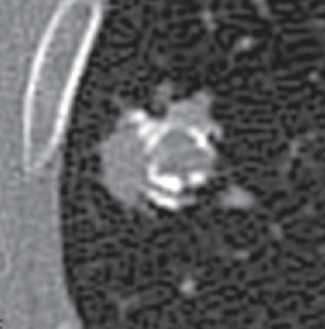Concentric Calcification