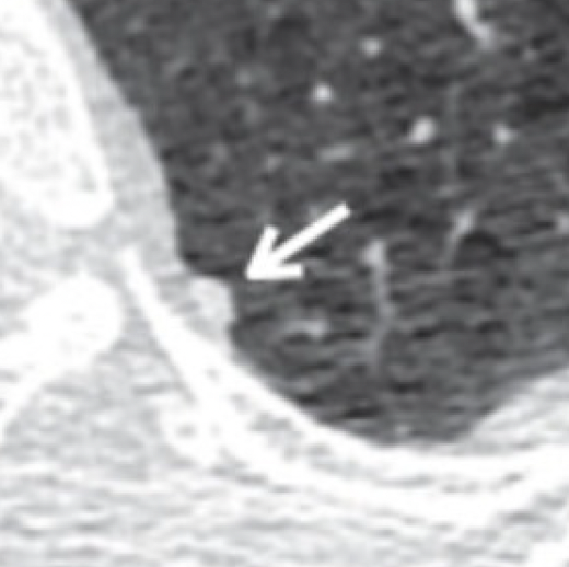 Costal Pleural
