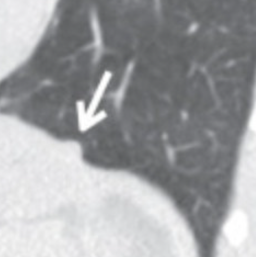 Peridiaphragmatic