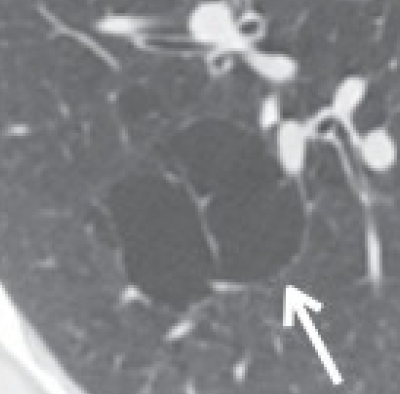 Internal Septation